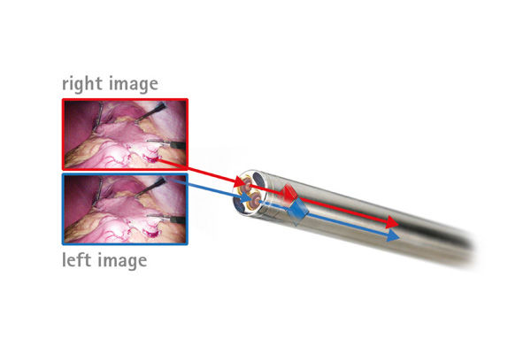 Beispiel für Chip-on-the-Tip 3D-Kamerasysteme